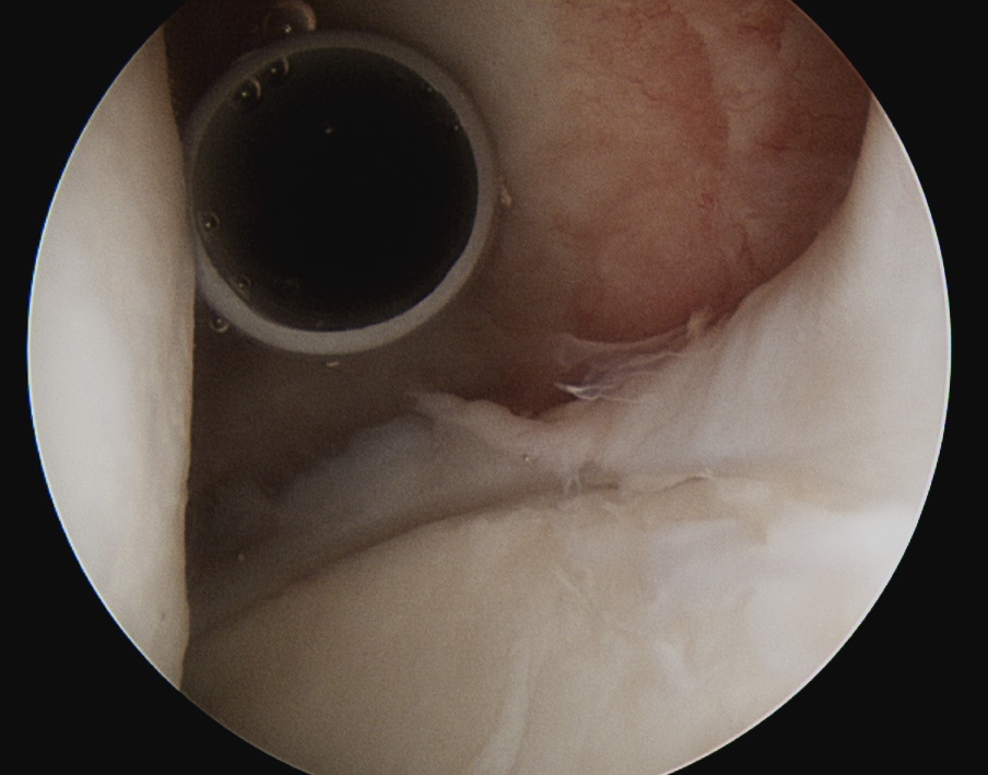 Shoulder Arthroscopy Posterior Portal